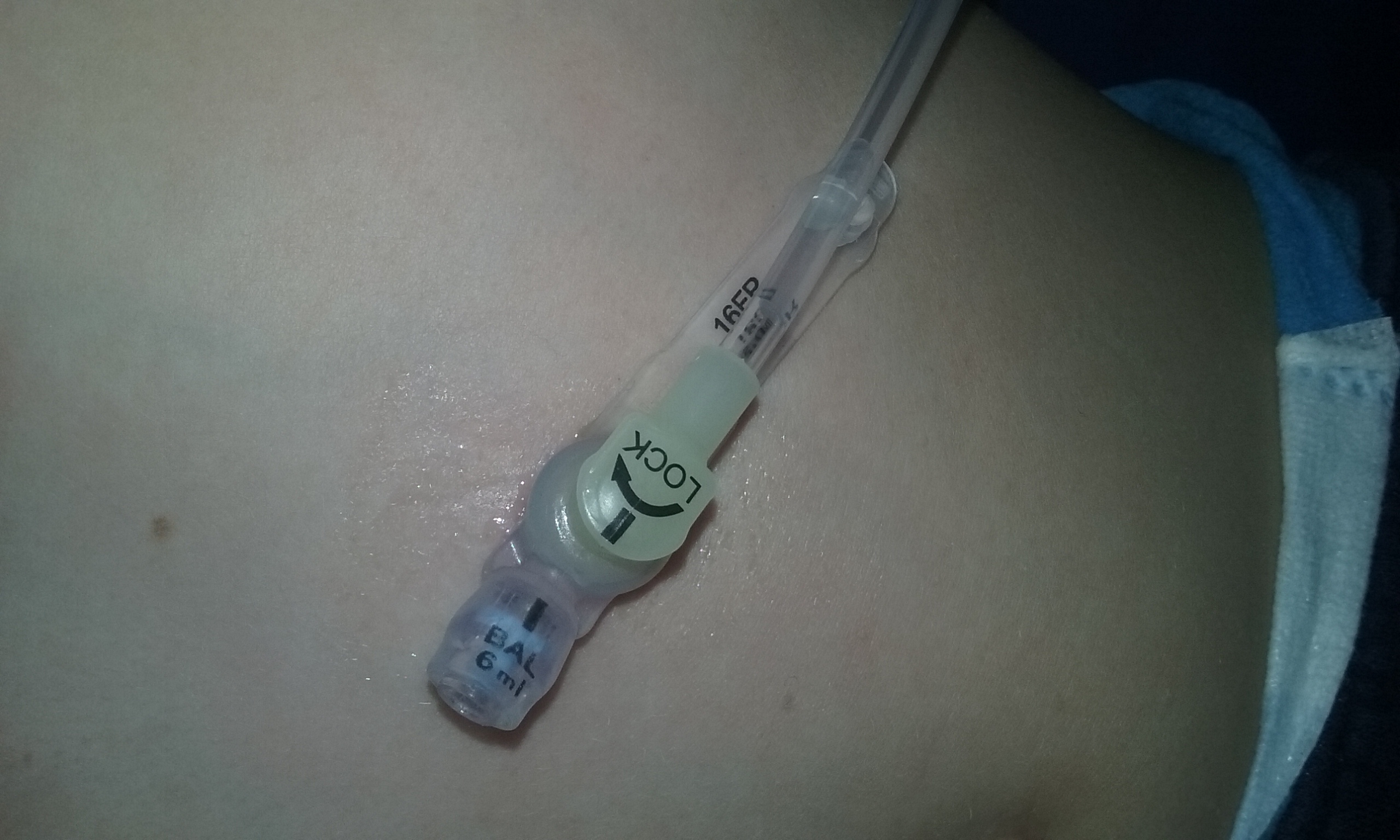 Daniel's G-tube with the feeding extension in place.